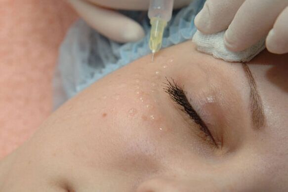 Mezoterapi - yüz cildi gençleştirme için bir enjeksiyon yöntemi