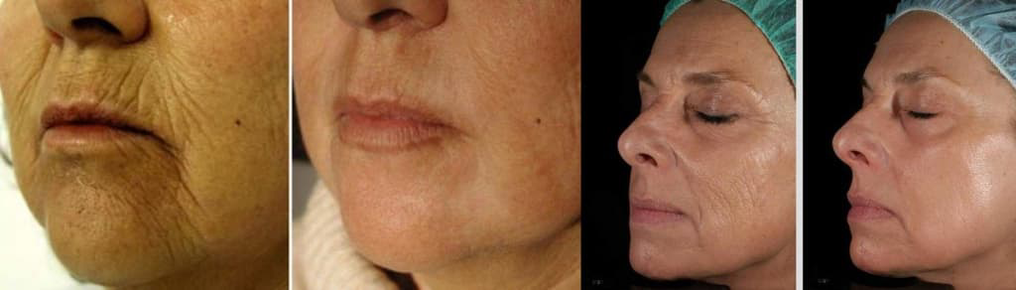 Lazer gençleştirme işleminden önce ve sonra yüz derisi