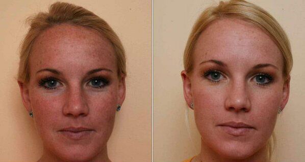 Lazerle yüz cildi gençleştirme öncesi ve sonrası