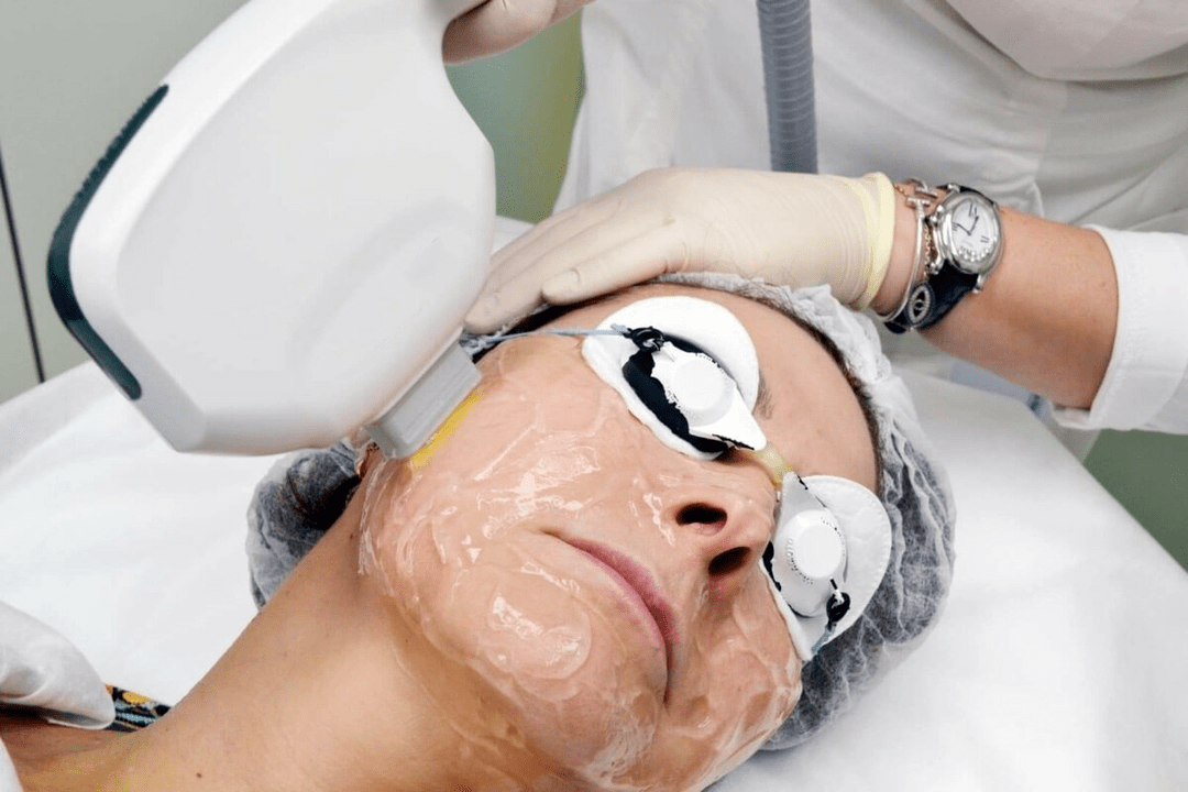 yüz cildi için lazer gençleştirme